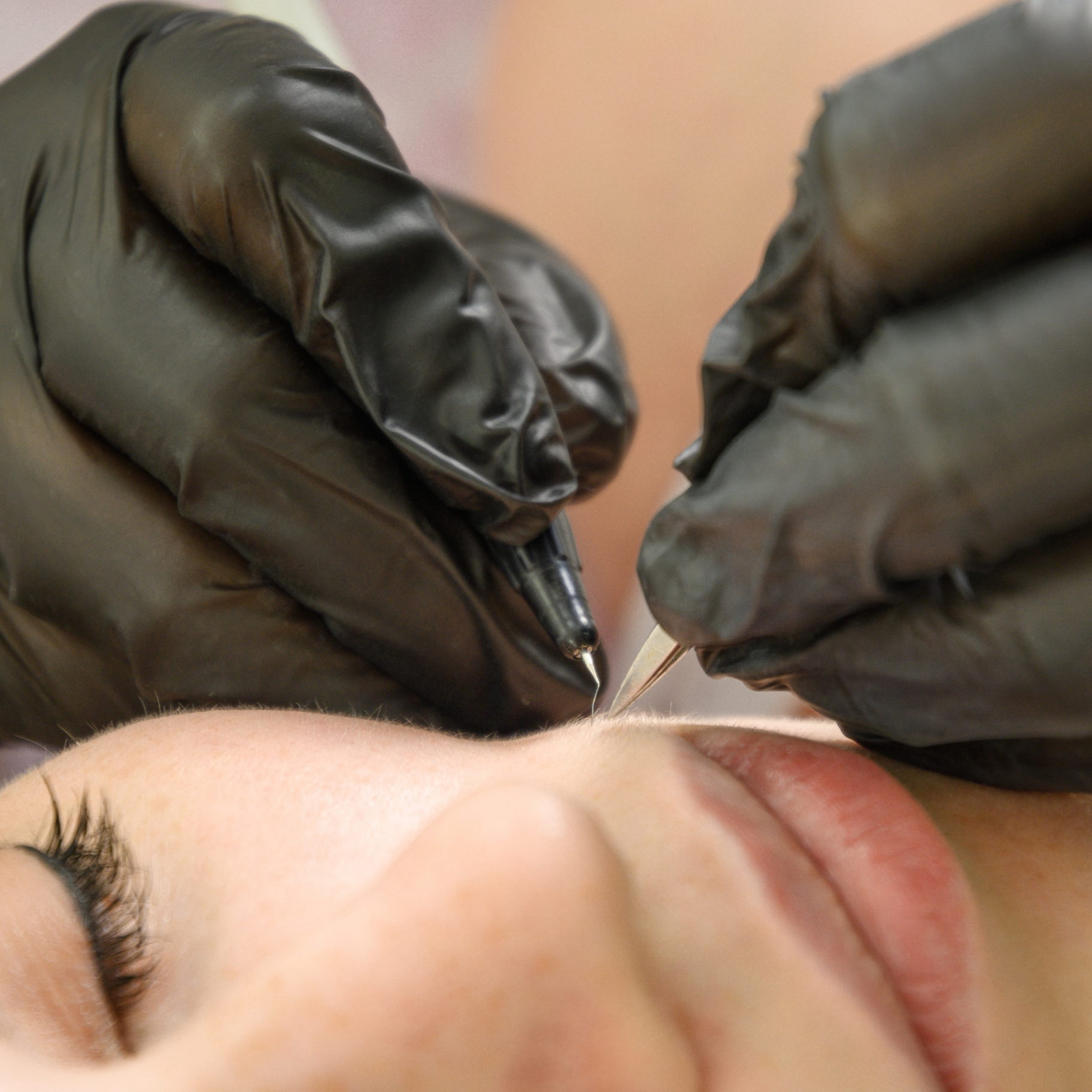 Geste d'électrolyse sur le visage