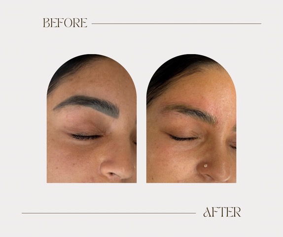 Détatouage de sourcils par lumière pulsée : avant et après le traitement